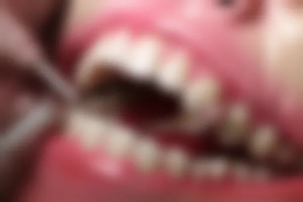 补牙后如果出现牙齿酸痛该如何处理？补牙后的护理与缓解方法解析