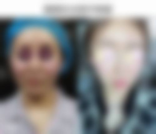 双眼皮割窄加宽修复手术后的修复时间揭秘