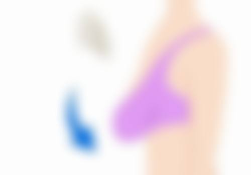 双眼皮割窄加宽修复手术的风险与应对策略