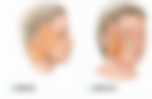 外切眼袋手术修复时间的全方面成效