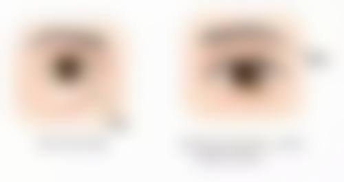 脂肪隆胸伤口修复要多久：小针眼的护理秘诀