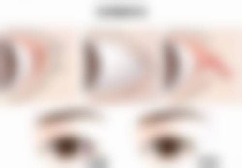 注射隆鼻注射的风险防范