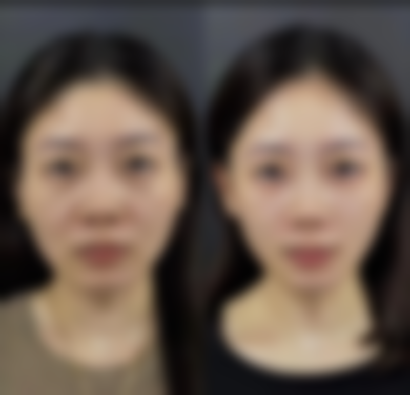 艾条去除眼袋的原理大揭秘