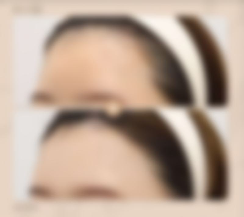 使用艾条去除眼袋的成效评估