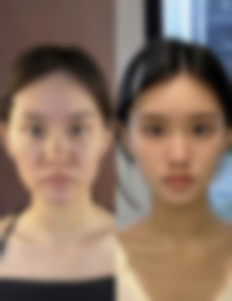 艾条去除眼袋有副作用吗