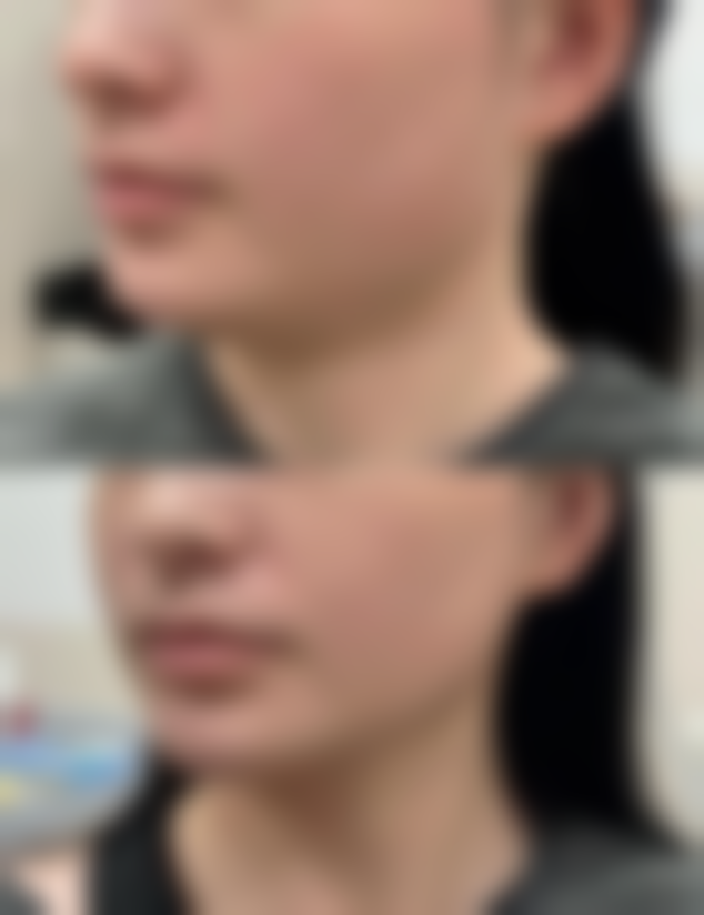 双眼皮割窄了可以加宽吗，修复手术费用+恢复时间全解析