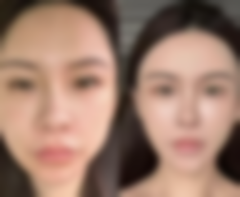 长痘痘留的疤痕怎么去除——手术祛疤：谨慎开启的终极武器