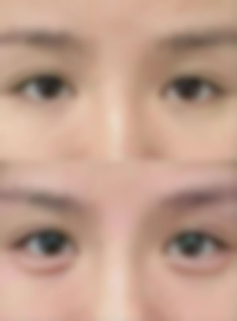 隆鼻玻尿酸什么价之隐藏成本解析