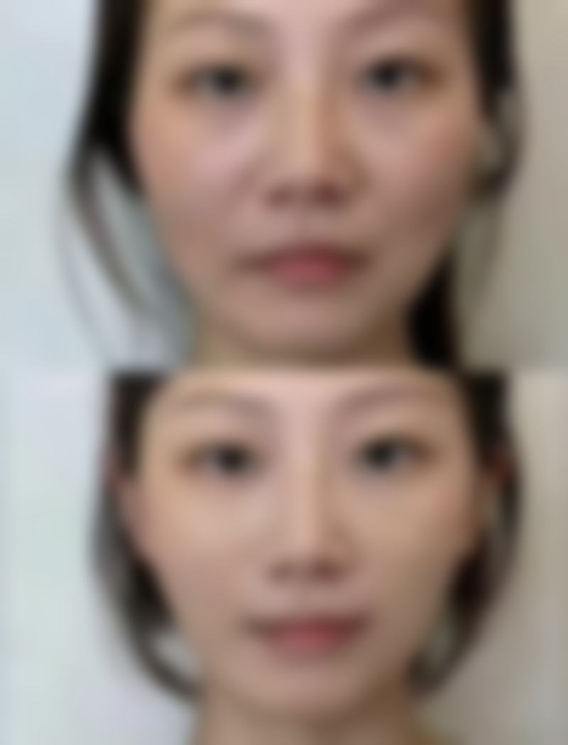 注射隆鼻注射的显著成效