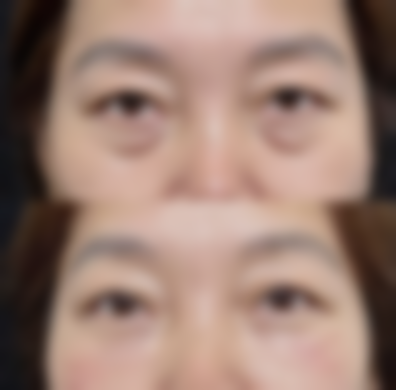 隆鼻玻尿酸什么价之有名品牌价格剖析