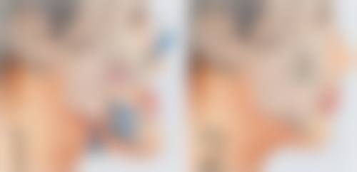 隆鼻打什么消炎针成效更好之克林霉素：对抗厌氧菌的秘密武器