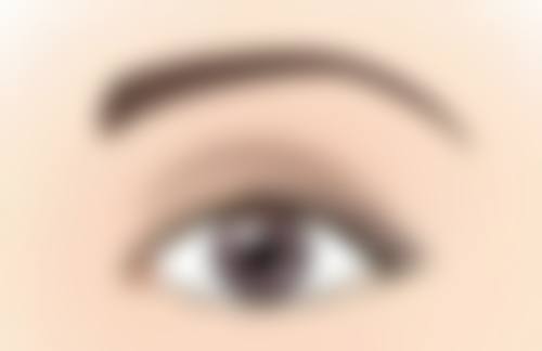 双眼皮拆线后眼角有点小疙瘩怎么办？成因+消除方法+护理指南