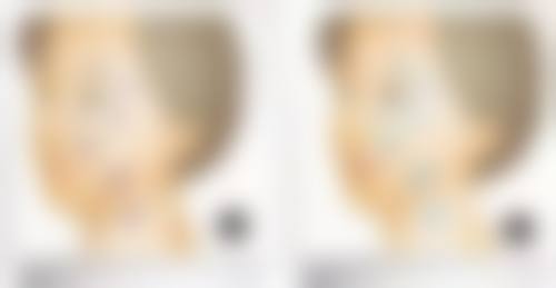 金柯桥医院双眼皮常见问题Q&A