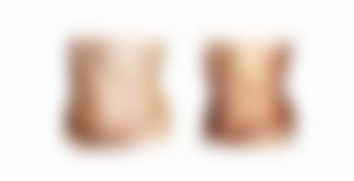 切开双眼皮维持时长受眼部基础的影响