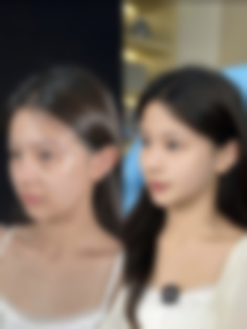 切开双眼皮可以维持多久？医生技术+护理方法决定你的美丽年限