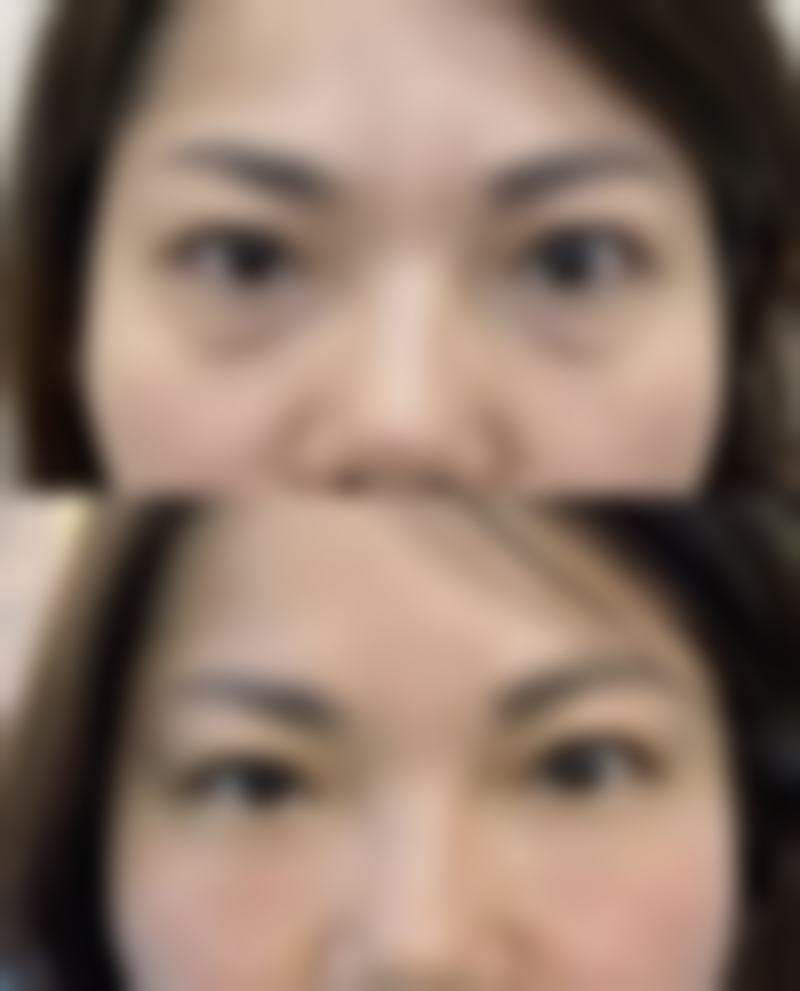 双眼皮做哪种最好？欧式平行型vs扇形埋线，金柯桥整形医院微创技术揭秘