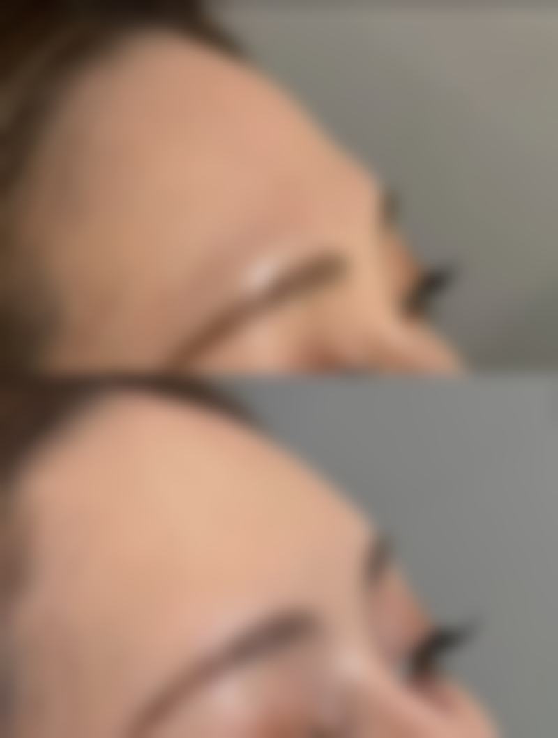 头发种植究竟好不好——修复篇