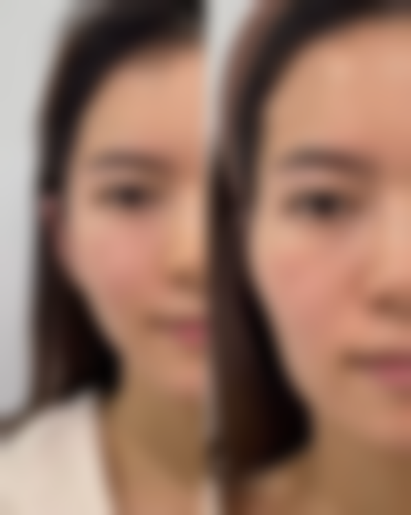 甲状腺手术后有疤痕增生怎么办之3招淡化增生疤痕