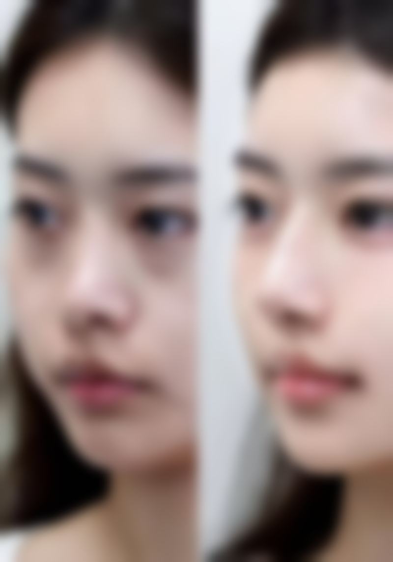 硅胶假体隆胸可以用力抓吗