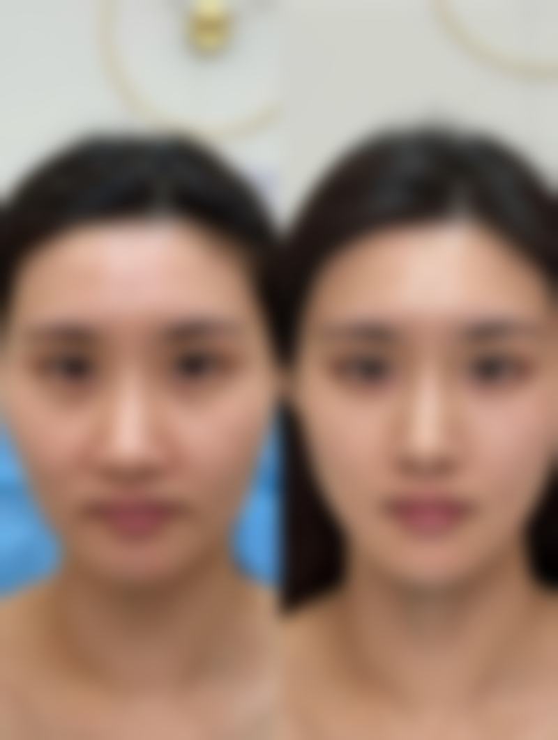 双眼皮拆线后眼角小疙瘩的保湿防晒护理