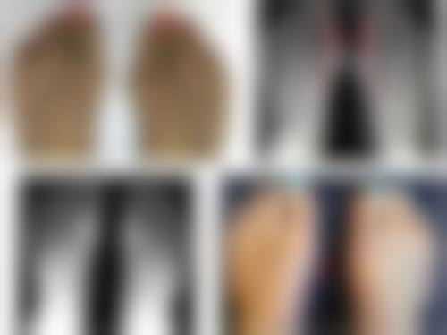 吸脂后不同时间段做射频紧肤的成效对比：选对时机特别重要