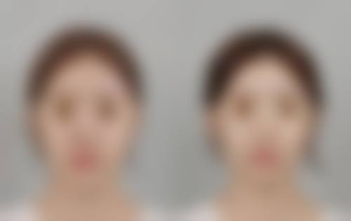 手臂吸脂多久可以修复——塑身衣穿戴全攻略