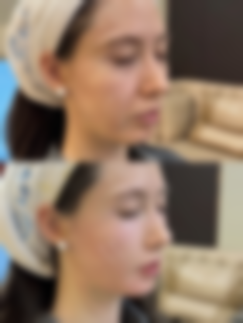 手臂吸脂多久可以修复——不同类型医院的修复时间差异