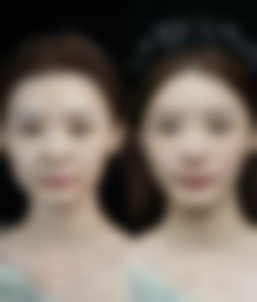 臀部抽脂多久才能消肿：15天基本修复的“翘臀计划”