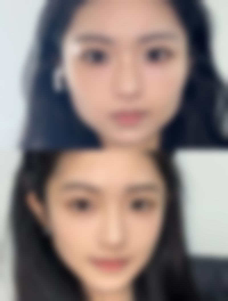 身体各部位吸脂后多久做射频紧肤：精细护理指南