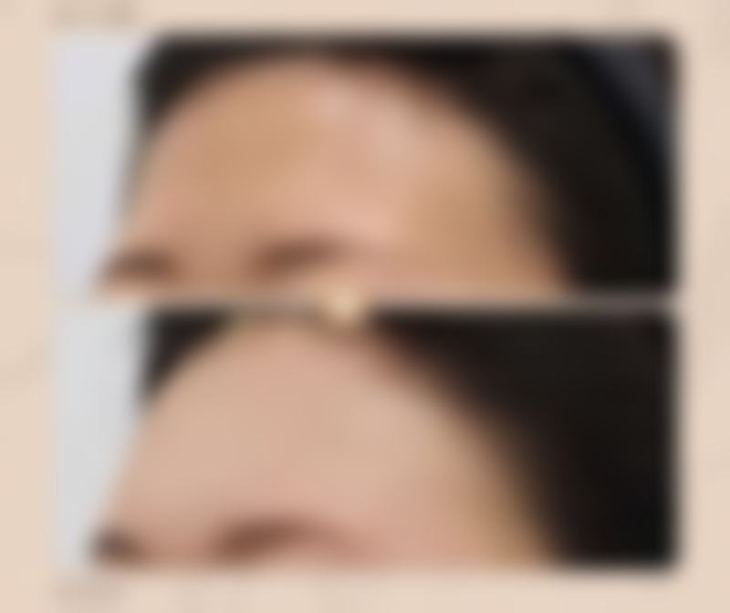 内窥镜隆胸成效维持时长：材料、习惯与身体因素