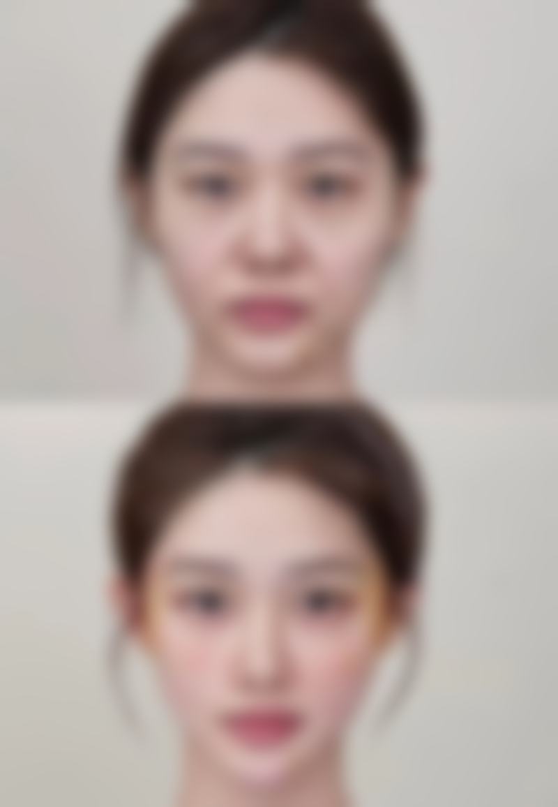 内窥镜隆胸有效果吗？术后10年自然如初，医生技术决定手感真实度