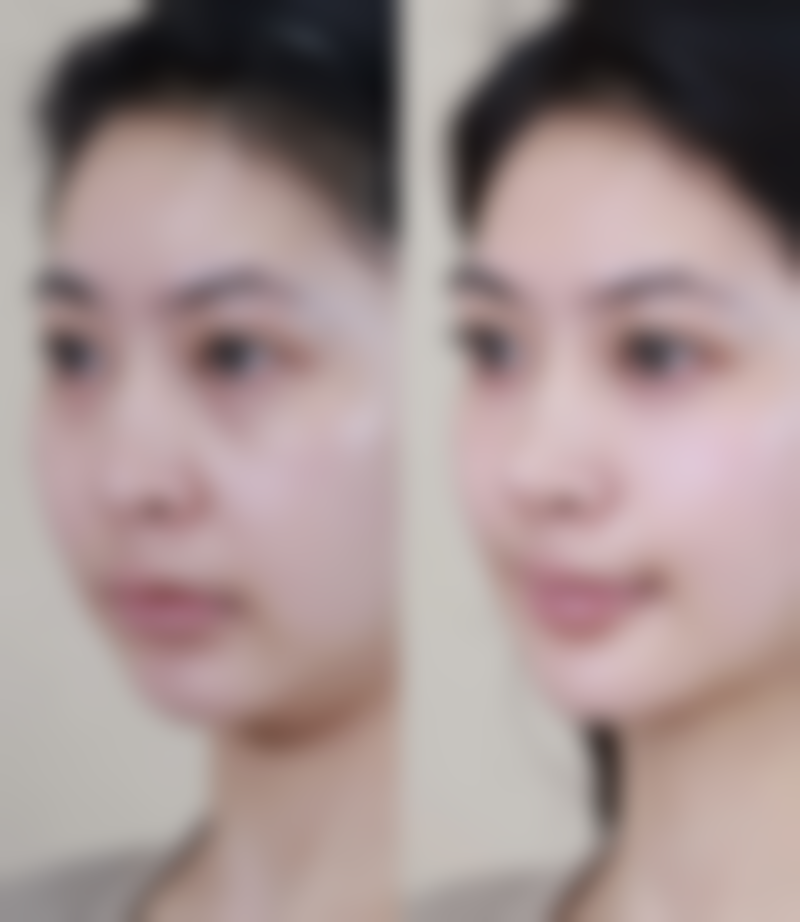 割双眼皮的埋线法修复：三等甲与私立医院下的快速变得更美