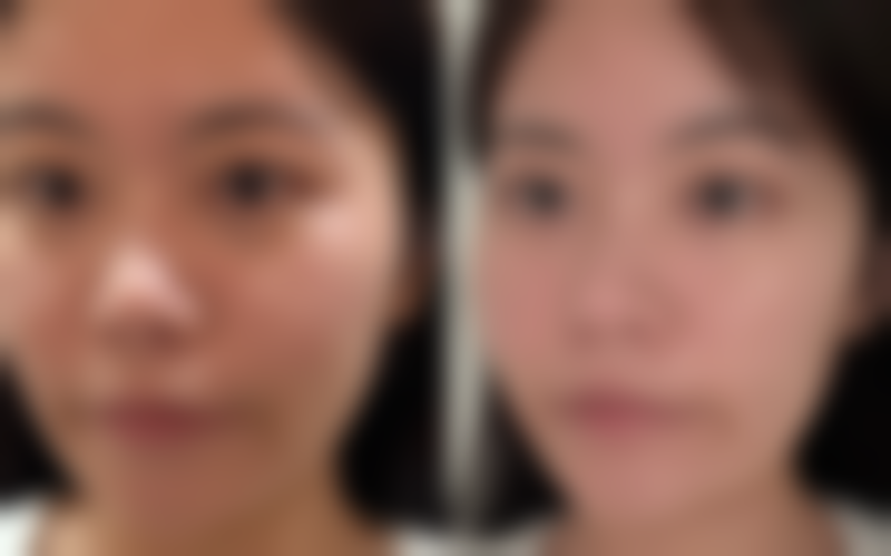 手臂吸脂多久可以恢复，三甲医院专业解答+术后塑身衣穿戴指南