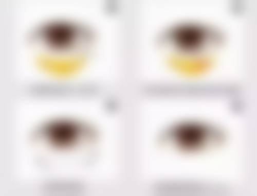 手臂抽脂后多久可以见成效：告别“拜拜肉”的漫长进度条