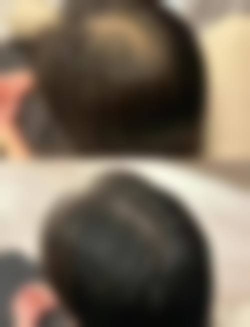 西安熙朵植发医院价格表详情