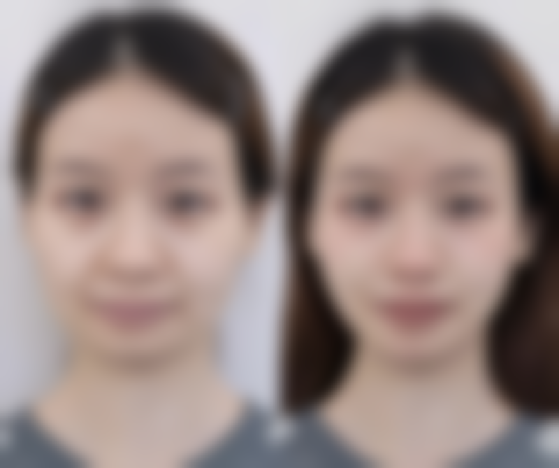 打瘦脸针多久恢复自然？1个月见效3个月稳定，护理要点全解析