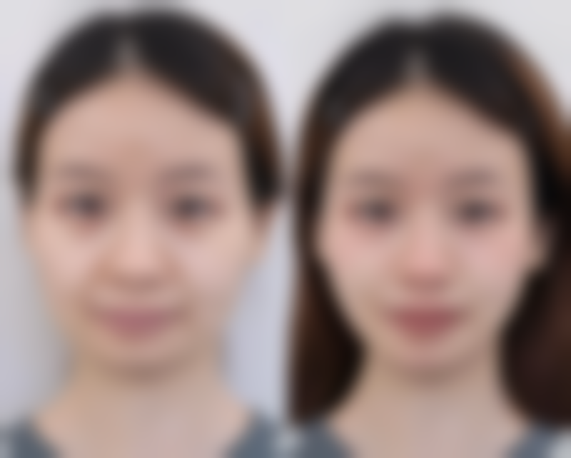 辽宁杏林医院分享14天肿胀护理全攻略