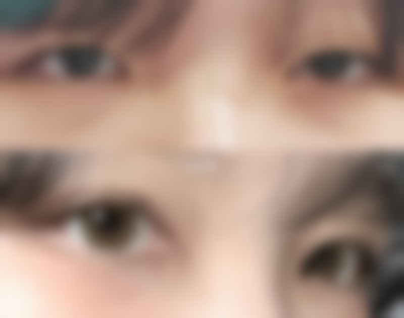 凹陷的疤痕自然修复能去掉吗