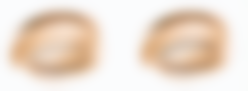 上海地区自体隆鼻成效持久性调查:地域差异真的存在吗?