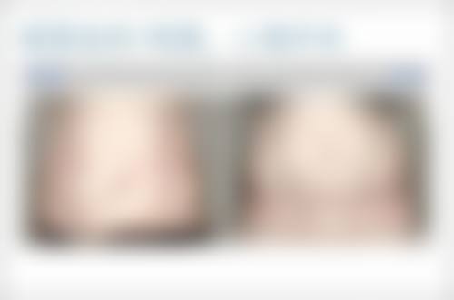 双眼皮拆线过后多久可以涂祛疤？拆线1-2天最佳时机，硅酮凝胶祛疤效果惊艳！