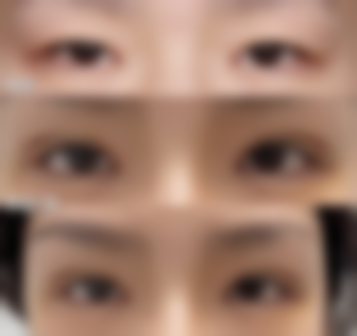 埋线双眼皮医院专精与一个宽一个窄修复方法大全