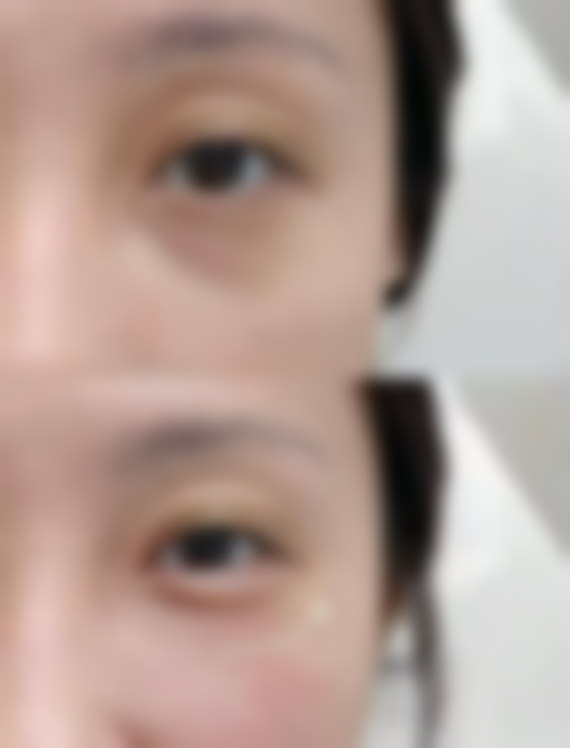 双眼皮拆线过后一周涂祛疤还来得及吗：抓住疤痕增生关键期