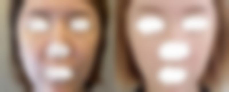 假体隆胸后取出疼吗？北京上海三甲医院专家解析术后真实感受