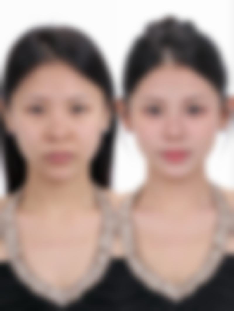 隆胸手术属于大手术吗？价格背后的秘密