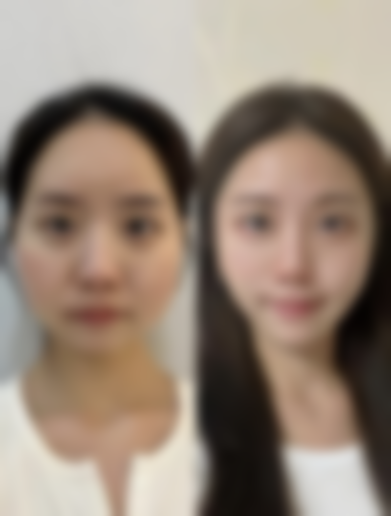 埋线双眼皮医院建议与终极问答：多久能修复好