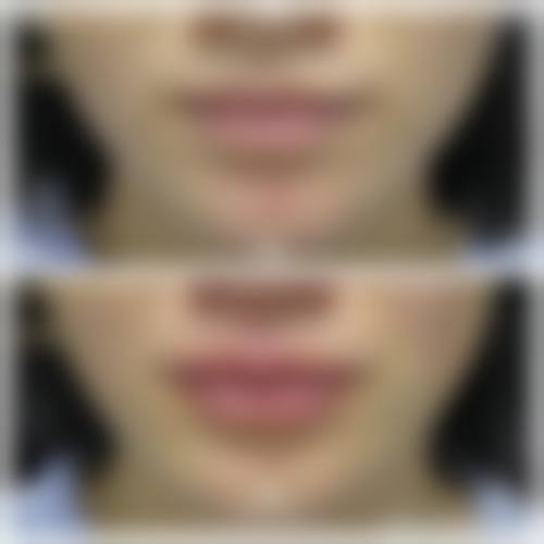 南通英莎医疗美容门诊部李辉做过的真实反馈——南通沈美医疗美容诊所