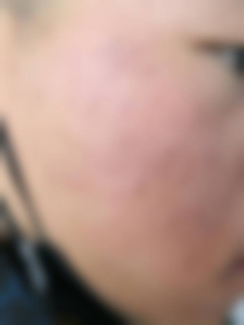 佛山市妇幼保健院皮肤美容科抖音团购活动和价格表怎么样