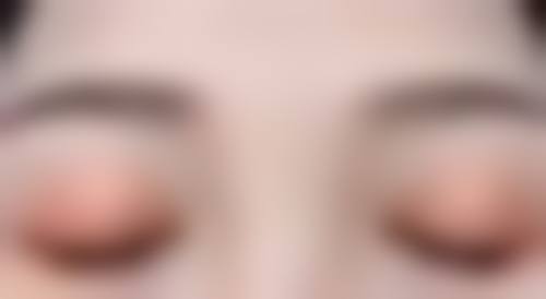 自体隆鼻软骨有什么后遗症——肿胀不消的困扰与应对