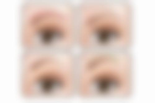 哪些情况必须取埋线双眼皮