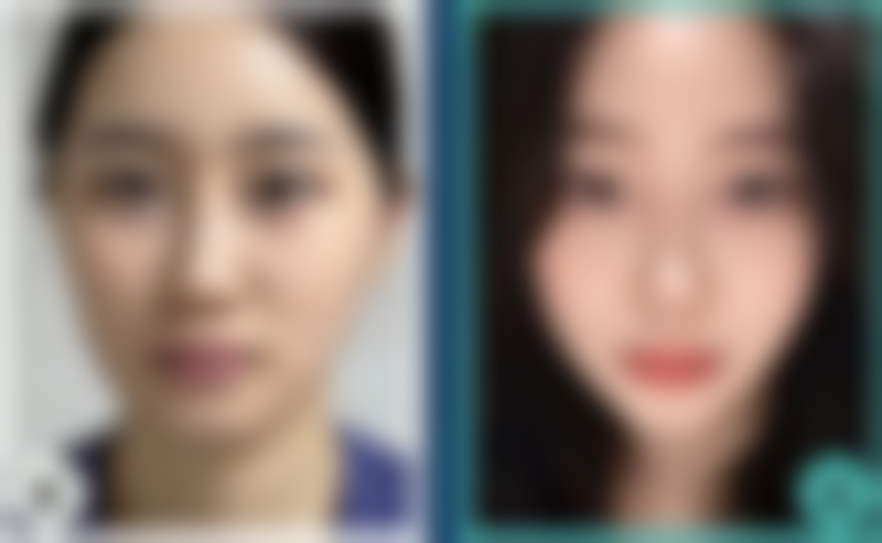 膨体硅胶隆鼻哪个好之术后成效对比:医院反馈呈现谁更“天生丽质”?